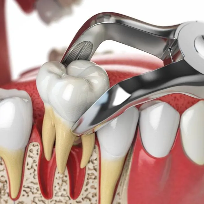 teeth-extractions-hamptons-dental Tooth extraction procedure